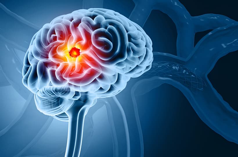 Neurosurgery
